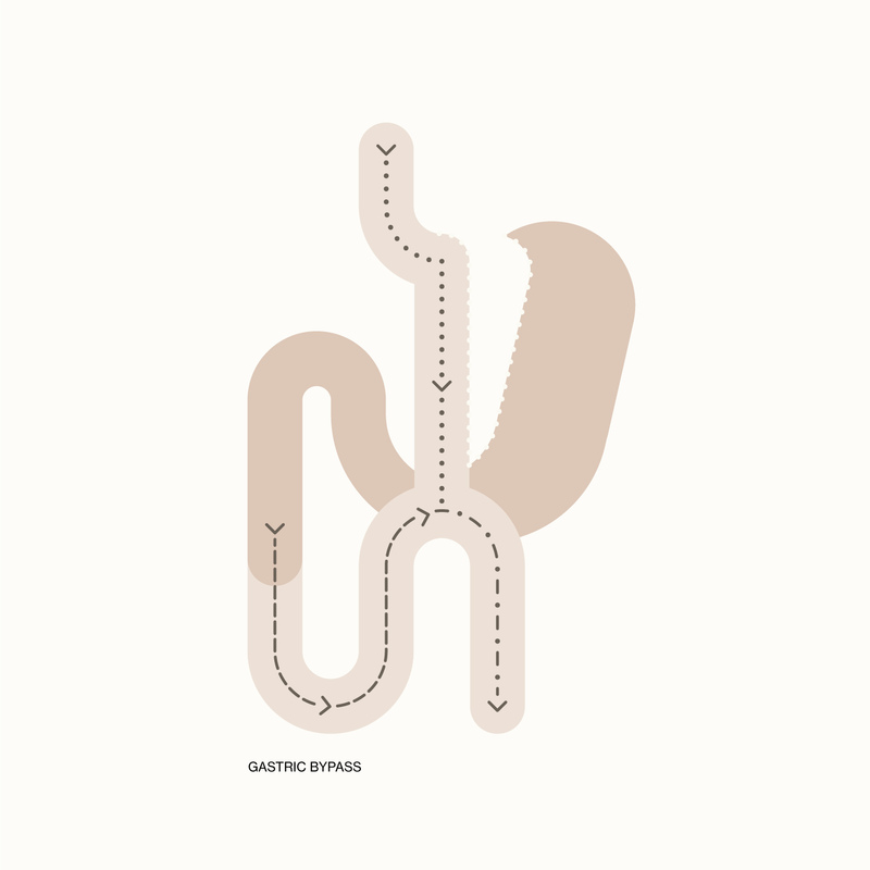 Illustration of a One Anastomosis Gastric Bypass procedure, as performed by Dr George Balalis. 